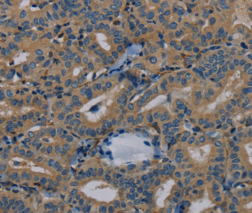 Immunohistochemistry of paraffin-embedded Human thyroid cancer tissue using PYY Polyclonal Antibody at dilution 1:40