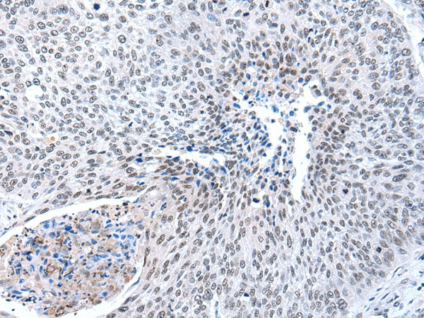 Immunohistochemistry of paraffin-embedded Human lung cancer tissue  using MORC2 Polyclonal Antibody at dilution of 1:25(?200)