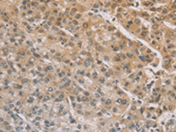 Immunohistochemistry of paraffin-embedded Human liver cancer tissue  using ZIC2  Polyclonal Antibody at dilution of 1:100(?200)