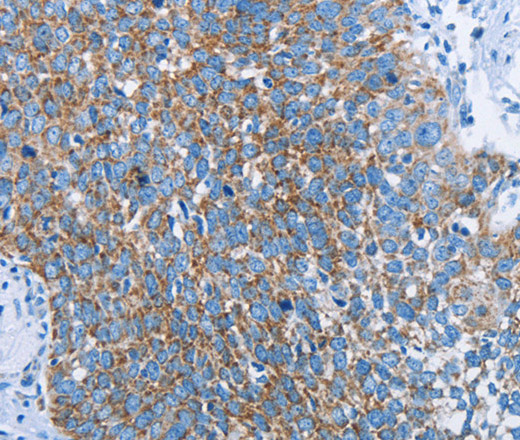 Immunohistochemistry of paraffin-embedded Human cervical cancer tissue using HINT2 Polyclonal Antibody at dilution 1:40