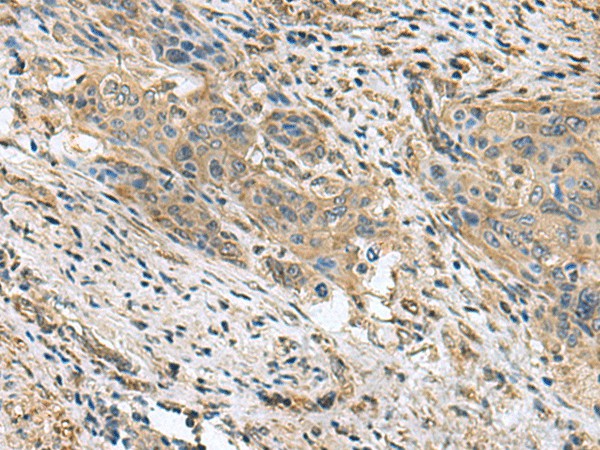 Immunohistochemistry of paraffin-embedded Human cervical cancer tissue  using PAPSS2 Polyclonal Antibody at dilution of 1:60(?200)