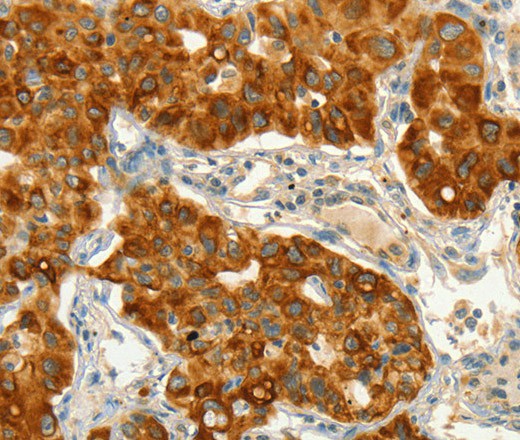 Immunohistochemistry of paraffin-embedded Human lung cancer tissue using CIB1 Polyclonal Antibody at dilution 1:50