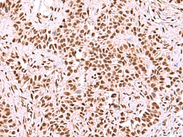 Immunohistochemistry of paraffin-embedded Human ovarian cancer tissue  using SF3B3 Polyclonal Antibody at dilution of 1:50(?200)