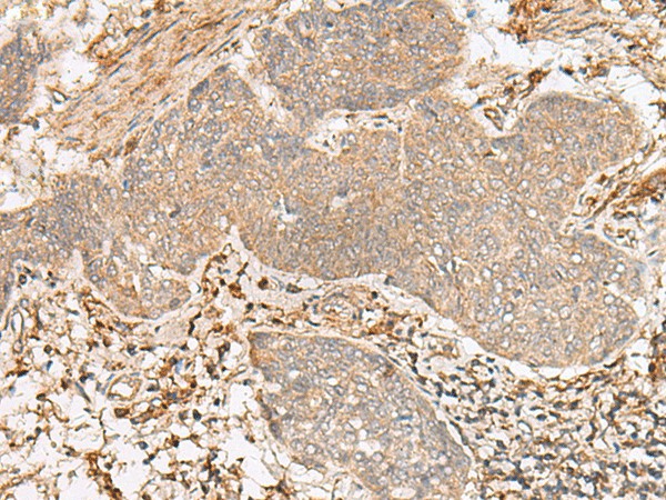 Immunohistochemistry of paraffin-embedded Human esophagus cancer tissue  using FBXW8 Polyclonal Antibody at dilution of 1:65(?200)