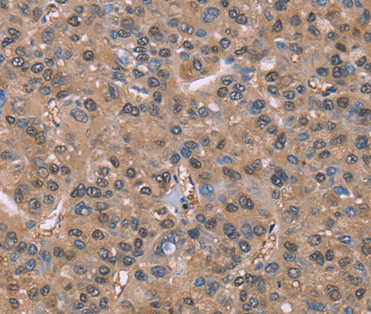 Immunohistochemistry of paraffin-embedded Human liver cancer tissue using GLYR1 Polyclonal Antibody at dilution 1:30