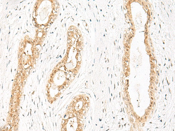 Immunohistochemistry of paraffin-embedded Human breast cancer tissue  using JPT1 Polyclonal Antibody at dilution of 1:35(?200)