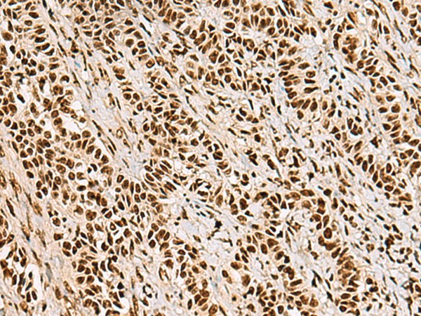 Immunohistochemistry of paraffin-embedded Human ovarian cancer tissue  using FOXI1 Polyclonal Antibody at dilution of 1:55(?200)