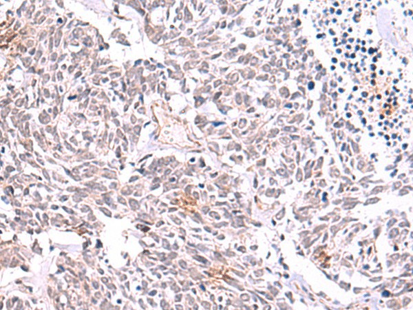 Immunohistochemistry of paraffin-embedded Human lung cancer tissue  using TRMT12 Polyclonal Antibody at dilution of 1:85(?200)