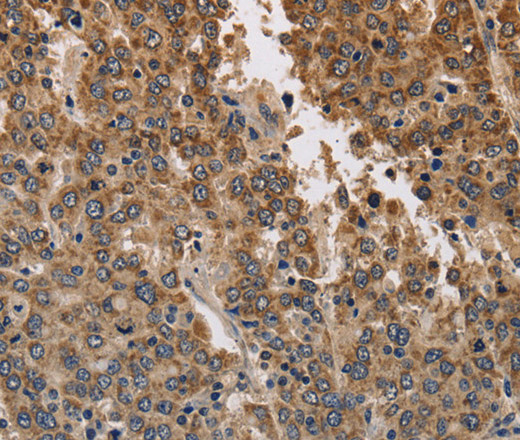 Immunohistochemistry of paraffin-embedded Human liver cancer using KCNK9 Polyclonal Antibody at dilution of 1:40