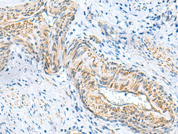 Immunohistochemistry of paraffin-embedded Human cervical cancer tissue  using MYL1 Polyclonal Antibody at dilution of 1:75(?200)