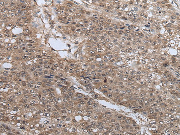 Immunohistochemistry of paraffin-embedded Human liver cancer tissue  using UBE4B Polyclonal Antibody at dilution of 1:40(?200)