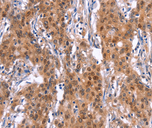 Immunohistochemistry of paraffin-embedded Human gastric cancer tissue using GPR124 Polyclonal Antibody at dilution 1:40