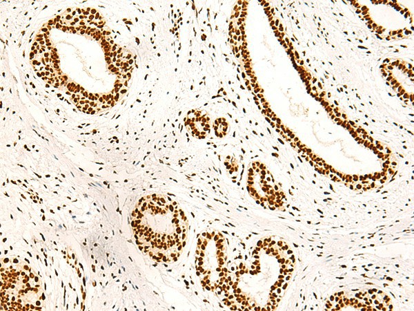 Immunohistochemistry of paraffin-embedded Human breast cancer tissue  using ILF3 Polyclonal Antibody at dilution of 1:40(?200)