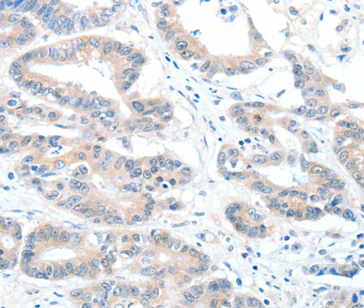 Immunohistochemistry of paraffin-embedded Human colon cancer using ALDH1A2 Polyclonal Antibody at dilution of 1:60