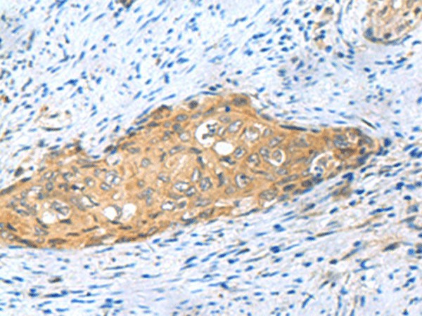 Immunohistochemistry of paraffin-embedded Human cervical cancer tissue  using MYDGF Polyclonal Antibody at dilution of 1:65(?200)