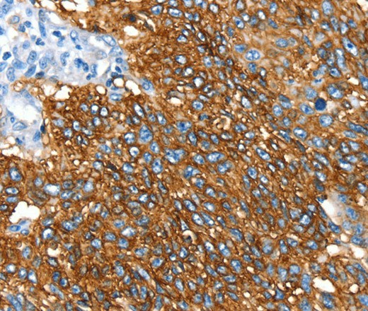 Immunohistochemistry of paraffin-embedded Human lung cancer using SNX5 Polyclonal Antibody at dilution of 1:30