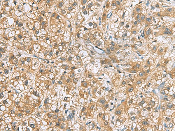 Immunohistochemistry of paraffin-embedded Human liver cancer tissue  using DNPH1 Polyclonal Antibody at dilution of 1:60(?200)