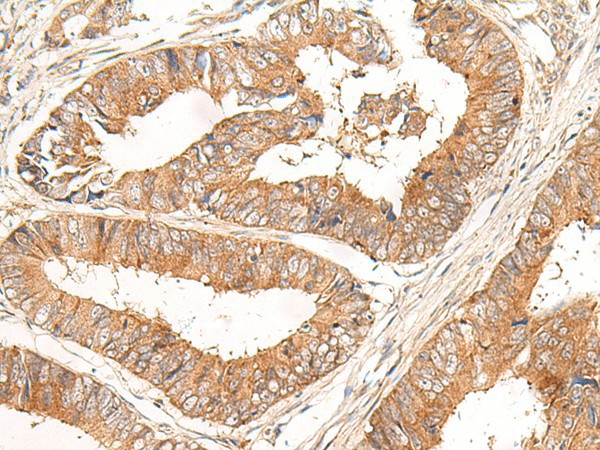 Immunohistochemistry of paraffin-embedded Human colorectal cancer tissue  using CORO2A Polyclonal Antibody at dilution of 1:30(?200)