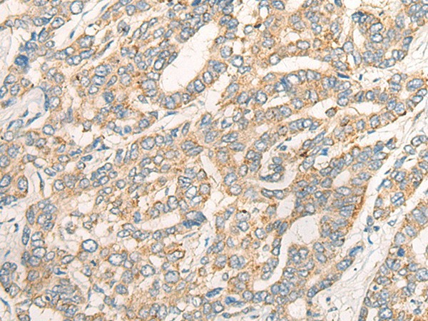 Immunohistochemistry of paraffin-embedded Human liver cancer tissue  using CCL16 Polyclonal Antibody at dilution of 1:45(?200)