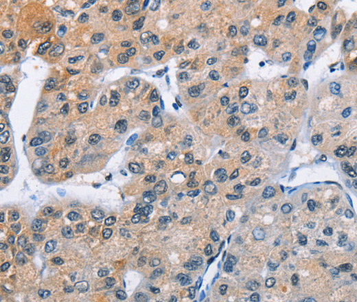 Immunohistochemistry of paraffin-embedded Human liver cancer using ATXN1 Polyclonal Antibody at dilution of 1:40