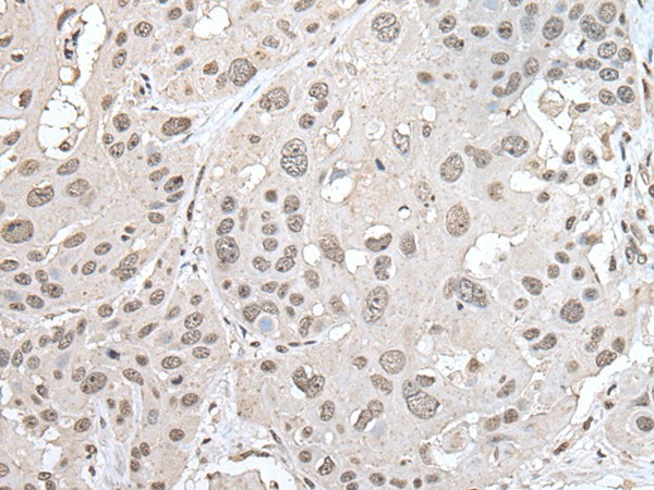 Immunohistochemistry of paraffin-embedded Human esophagus cancer tissue  using VRK1 Polyclonal Antibody at dilution of 1:30(?200)