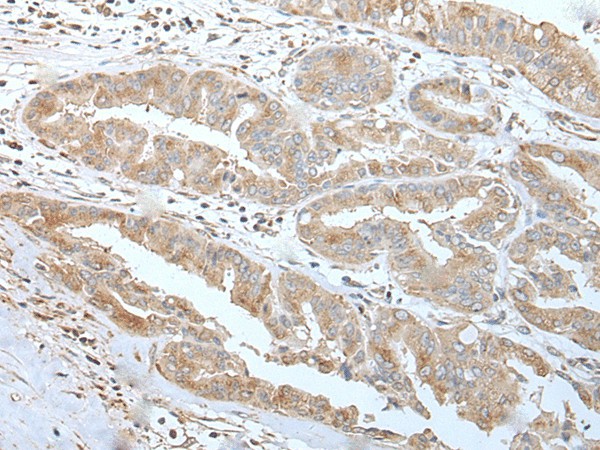 Immunohistochemistry of paraffin-embedded Human liver cancer tissue  using USO1 Polyclonal Antibody at dilution of 1:30(?200)