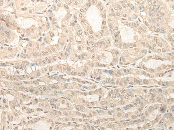 Immunohistochemistry of paraffin-embedded Human thyroid cancer tissue  using UBXN1 Polyclonal Antibody at dilution of 1:35(?200)