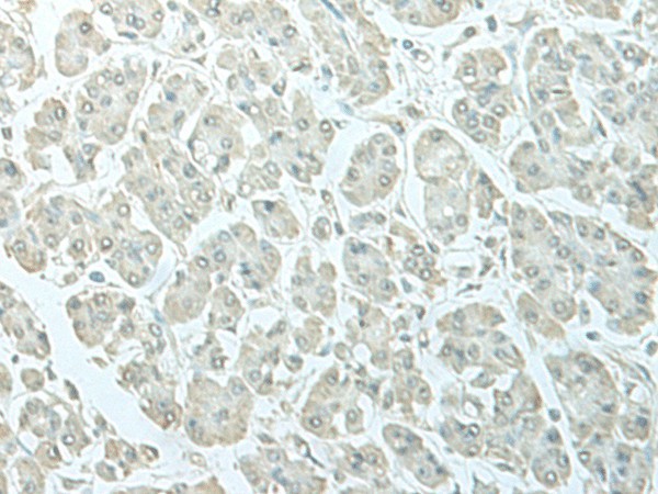 Immunohistochemistry of paraffin-embedded Human gastric cancer tissue  using C8orf4 Polyclonal Antibody at dilution of 1:55(?200)