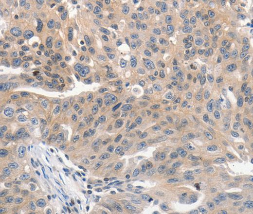 Immunohistochemistry of paraffin-embedded Human ovarian cancer tissue using PRKD1 Polyclonal Antibody at dilution 1:70