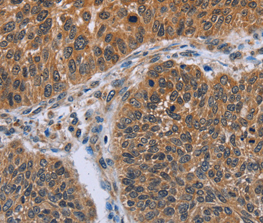 Immunohistochemistry of paraffin-embedded Human lung cancer tissue using IHH Polyclonal Antibody at dilution 1:30