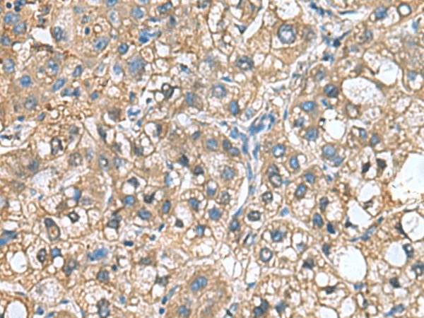 Immunohistochemistry of paraffin-embedded Human liver cancer tissue  using IGLL1 Polyclonal Antibody at dilution of 1:65(?200)