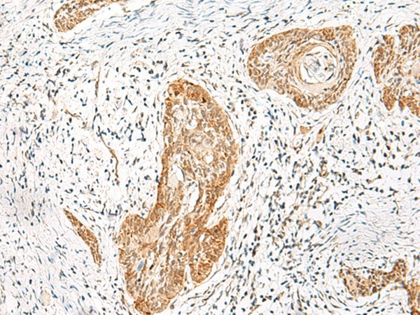 Immunohistochemistry of paraffin-embedded Human esophagus cancer tissue  using HNF1A Polyclonal Antibody at dilution of 1:25(?200)