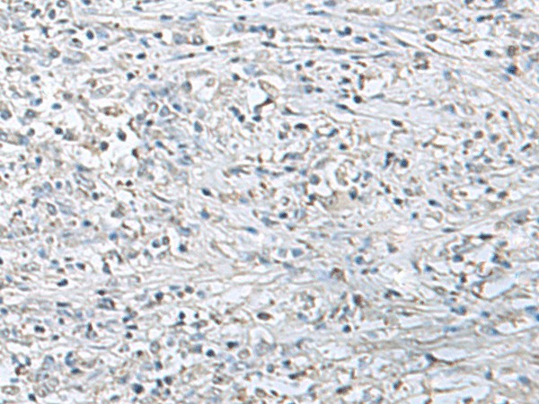 Immunohistochemistry of paraffin-embedded Human liver cancer tissue  using EPM2A Polyclonal Antibody at dilution of 1:55(?200)