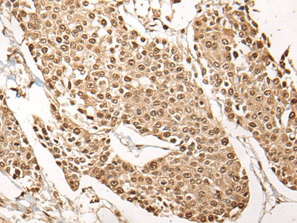 Immunohistochemistry of paraffin-embedded Human prost at e cancer tissue  using PCNA Polyclonal Antibody at dilution of 1:35(?200)