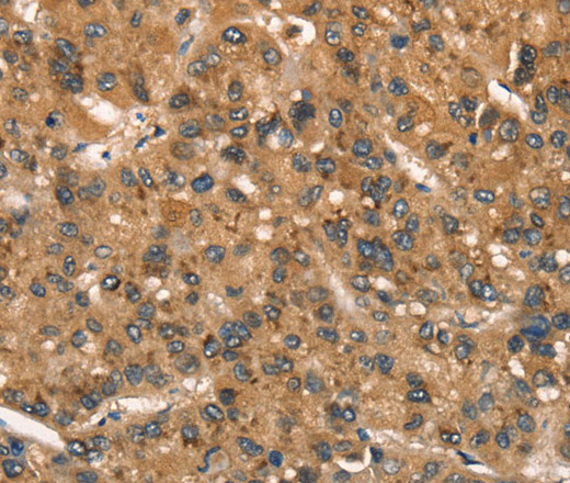 Immunohistochemistry of paraffin-embedded Human liver cancer tissue using CSTB Polyclonal Antibody at dilution 1:30