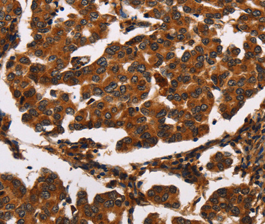 Immunohistochemistry of paraffin-embedded Human breast cancer tissue using ARSB Polyclonal Antibody at dilution 1:50