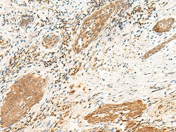 Immunohistochemistry of paraffin-embedded Human esophagus cancer tissue  using POLR1D Polyclonal Antibody at dilution of 1:50(?200)