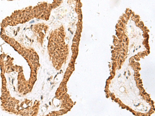 Immunohistochemistry of paraffin-embedded Human thyroid cancer tissue  using RALGAPA1 Polyclonal Antibody at dilution of 1:55(?200)