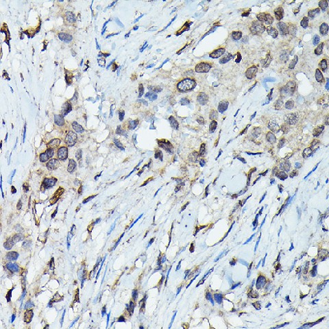 Immunohistochemistry of paraffin-embedded human esophageal cancer using C9orf72 Polyclonal Antibody at dilution of 1:100 (40x lens).Perform high pressure antigen retrieval with 10 mM citrate buffer pH 6.0 before commencing with IHC staining protocol.