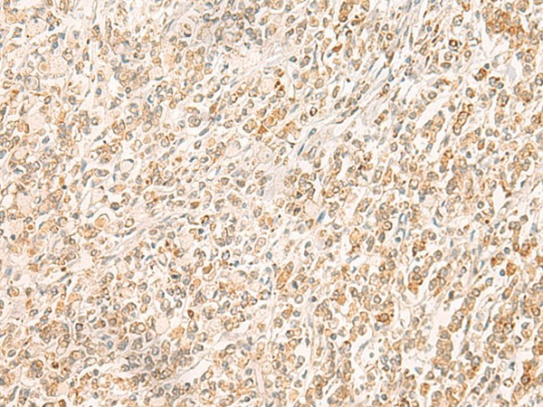 Immunohistochemistry of paraffin-embedded Human gastric cancer tissue  using MYCT1 Polyclonal Antibody at dilution of 1:35(?200)