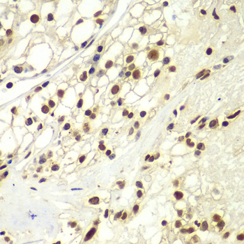 Immunohistochemistry of paraffin-embedded human kidney cancer using RPA2 Polyclonal Antibody at dilution of 1:100 (40x lens).Perform microwave antigen retrieval with 10 mM PBS buffer pH 7.2 before commencing with IHC staining protocol.