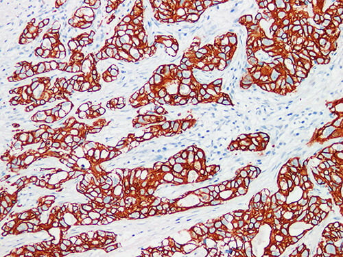 Immunohistochemistry of paraffinembedded Human breast cancer tissue with Cytokeratin 7 Monoclonal Antibody(Antigen repaired by EDTA).