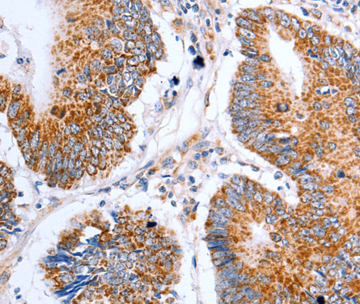 Immunohistochemistry of paraffin-embedded Human colon cancer tissue using Claudin 10 Polyclonal Antibody at dilution 1:50