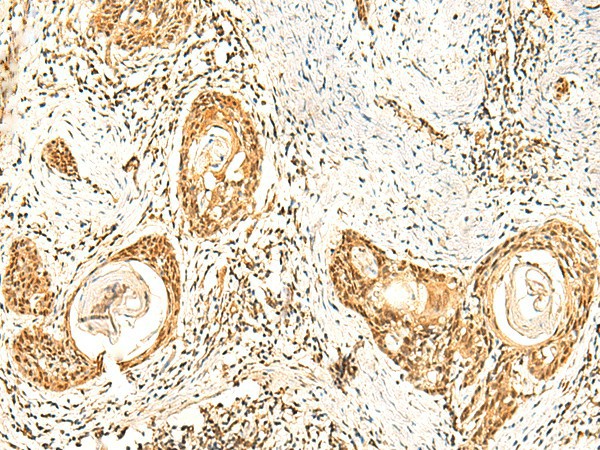 Immunohistochemistry of paraffin-embedded Human esophagus cancer tissue  using ZNF580 Polyclonal Antibody at dilution of 1:75(?200)