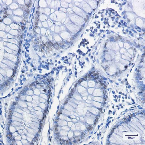 Immunohistochemistry of FUBP1 in paraffin-embedded Human colon cancer tissue using FUBP1 Rabbit mAb at dilution 1:100