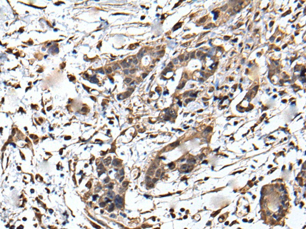 Immunohistochemistry of paraffin-embedded Human gastric cancer tissue  using ZFP36 Polyclonal Antibody at dilution of 1:55(?200)