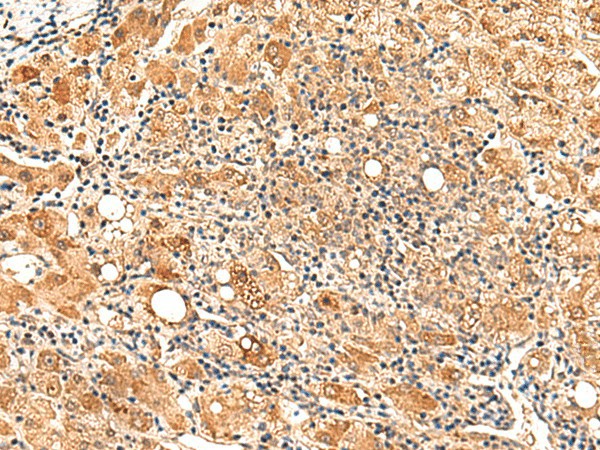 Immunohistochemistry of paraffin-embedded Human liver cancer tissue  using PAFAH1B2 Polyclonal Antibody at dilution of 1:50(?200)