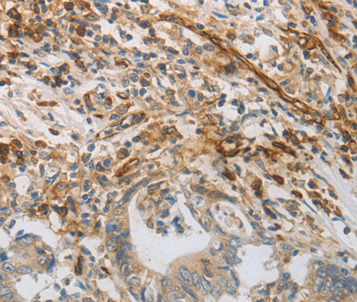 Immunohistochemistry of paraffin-embedded Human colon cancer using CD31 Polyclonal Antibody at dilution of 1:30