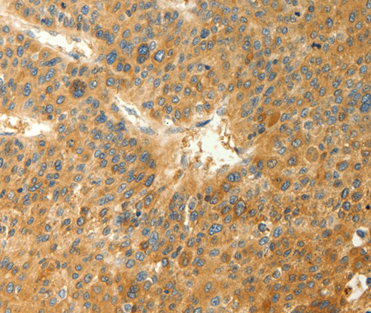 Immunohistochemistry of paraffin-embedded Human liver cancer tissue using RAB35 Polyclonal Antibody at dilution 1:40