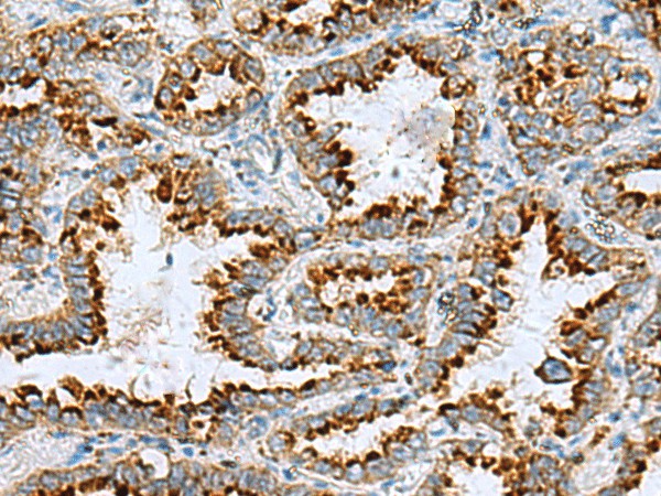 Immunohistochemistry of paraffin-embedded Human lung cancer tissue  using FAAP100 Polyclonal Antibody at dilution of 1:85(?200)